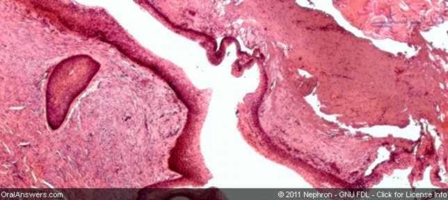 odontogenic-keratocyst cell level